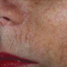 Before treatment