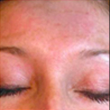 After treatment