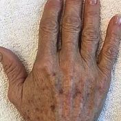 Before treatment