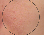 After treatment