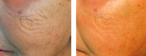 Pollogen LEGEND+ before and after