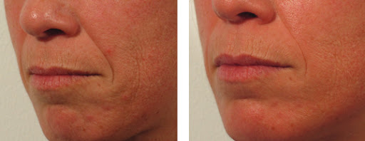 Pollogen LEGEND+ before and after