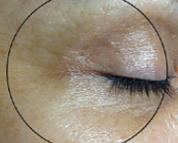 After treatment