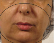 Before treatment