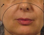 After treatment