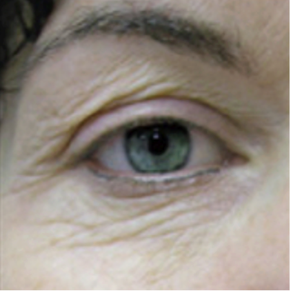 Before treatment
