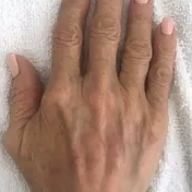After treatment