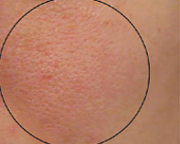 Before treatment