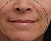 Before treatment