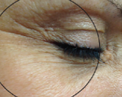 Before treatment