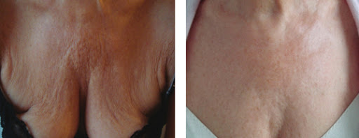 Pollogen LEGEND+ before and after