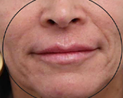 After treatment