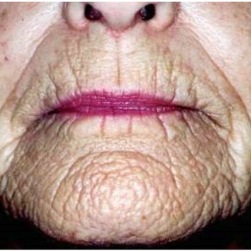 Before treatment