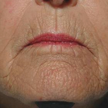 After treatment