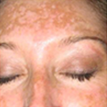 Before treatment